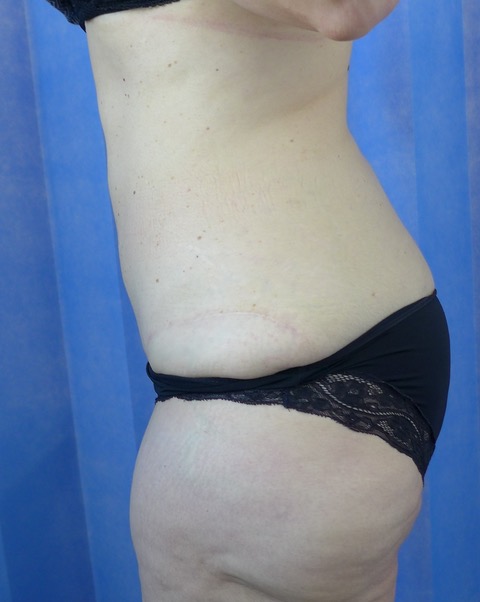 After — Fleur-de-Lys Abdominoplasty lateral view