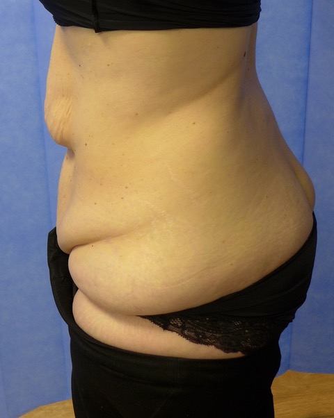 Before — Fleur-de-Lys Abdominoplasty lateral view