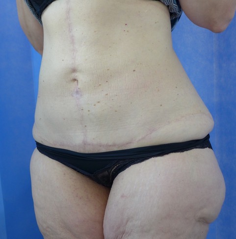 After — Fleur-de-Lys Abdominoplasty oblique view