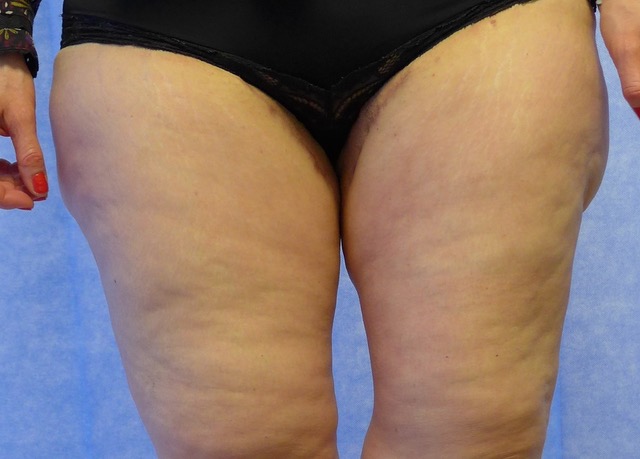 After — Thigh Lift AP