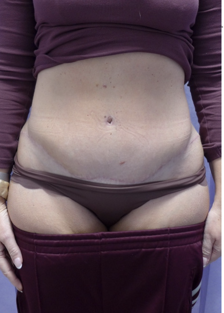 After — Abdominoplasty AP