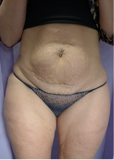 Before — Abdominoplasty AP