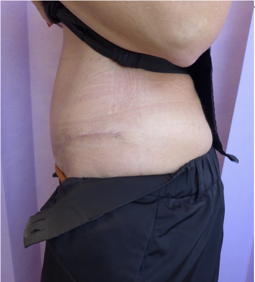 After — Abdominoplasty lateral