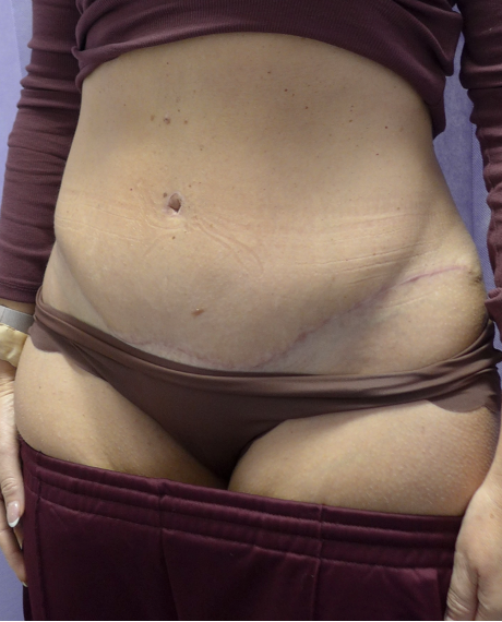 After — Abdominoplasty oblique