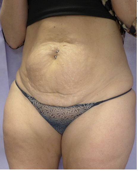 Before — Abdominoplasty oblique