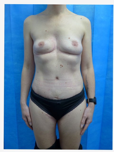 After — Bilateral Breast Reconstruction: LUG Flap & Bipedicled DIEP