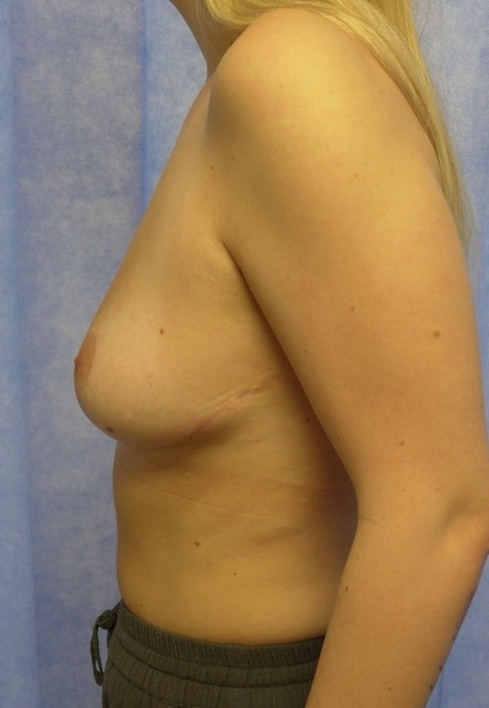 After — Breast Reduction lateral
