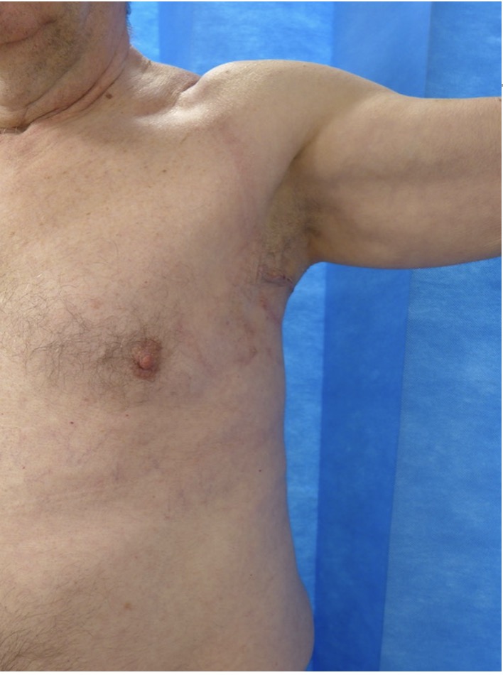 After — Lipoma Excision left axilla