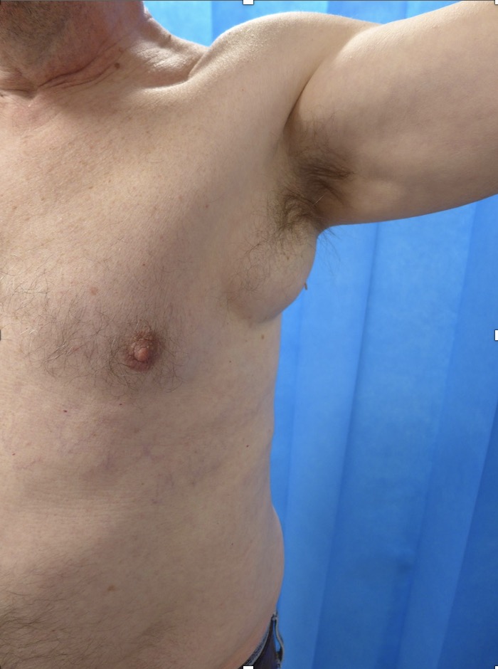 Before — Lipoma Excision left axilla