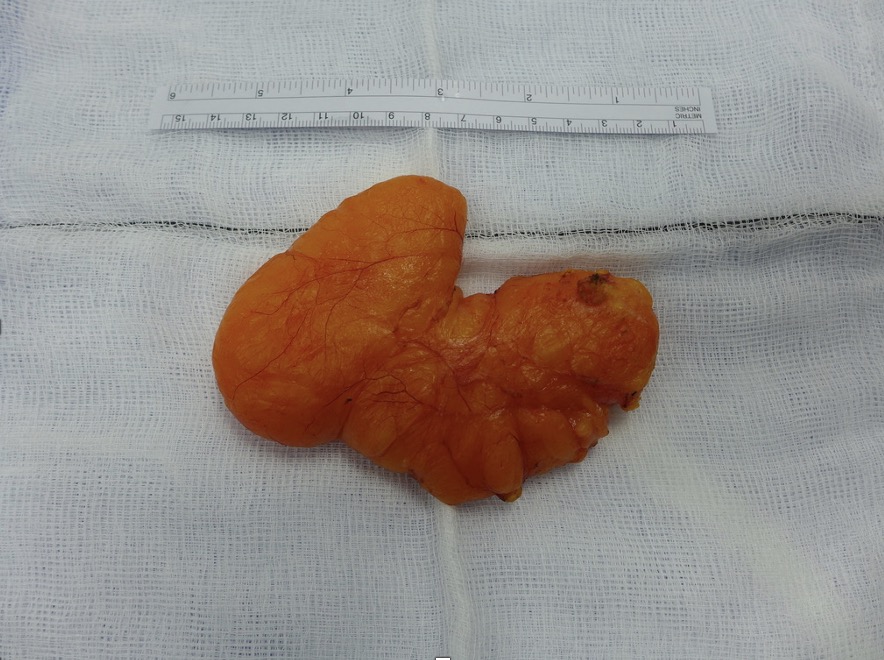 Lipoma specimen — 12×7×3 cm