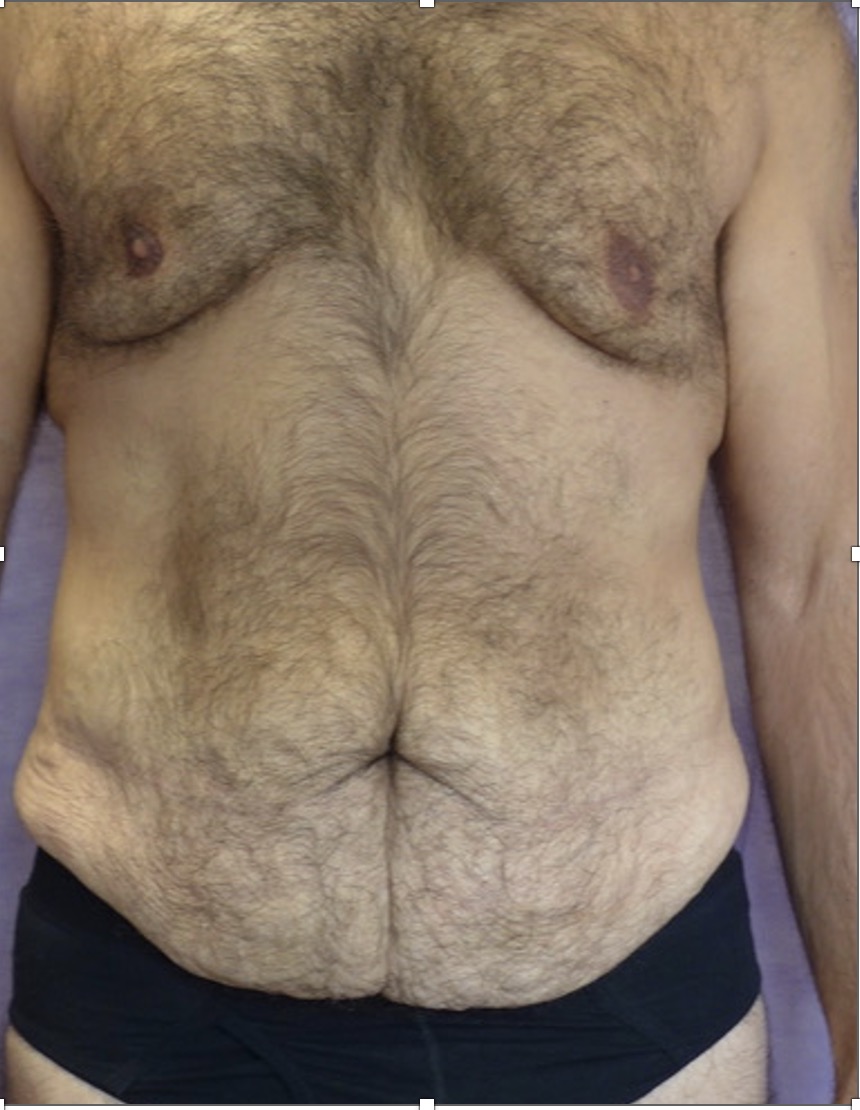 Before — Male Abdominoplasty AP