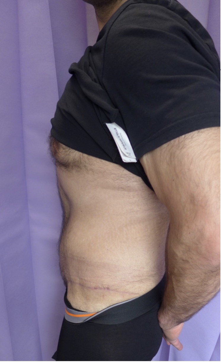 After — Male Abdominoplasty lateral