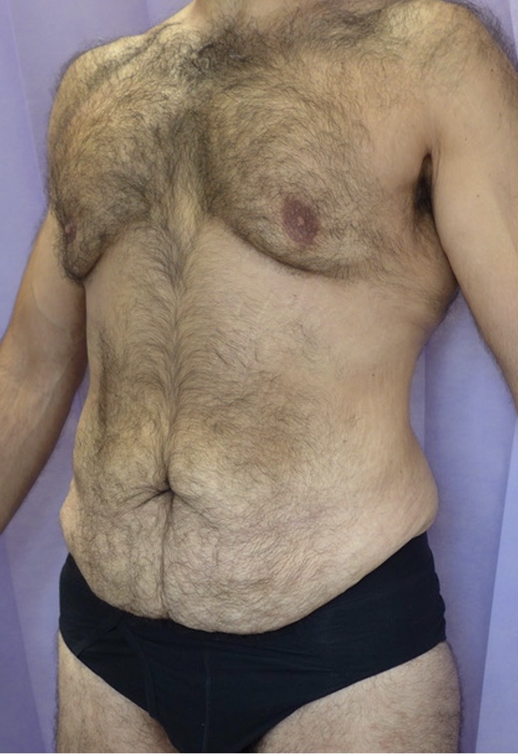 Before — Male Abdominoplasty oblique