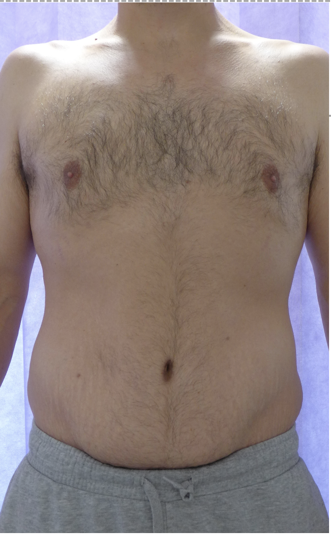 After — Male Abdominoplasty AP