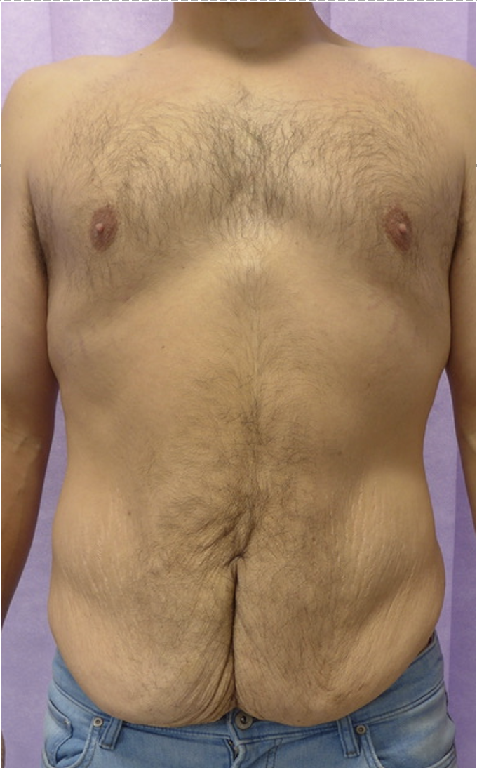Before — Male Abdominoplasty AP