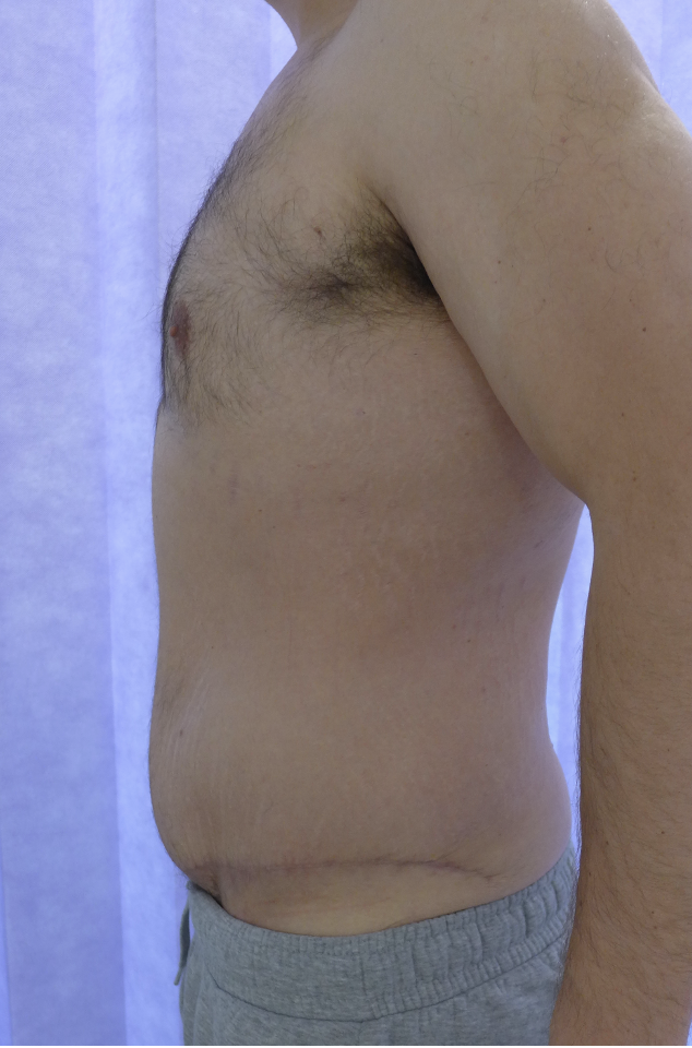 After — Male Abdominoplasty lateral