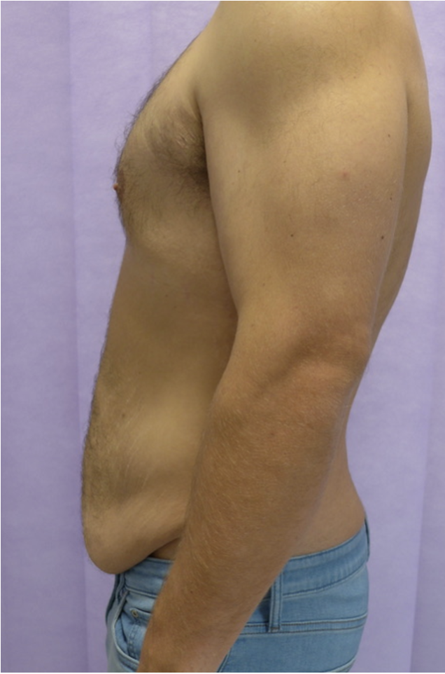 Before — Male Abdominoplasty lateral