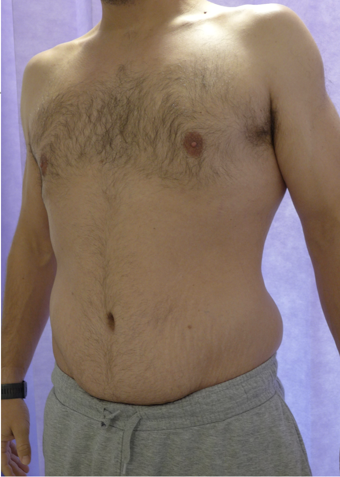 After — Male Abdominoplasty oblique