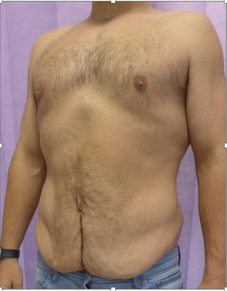 Before — Male Abdominoplasty oblique