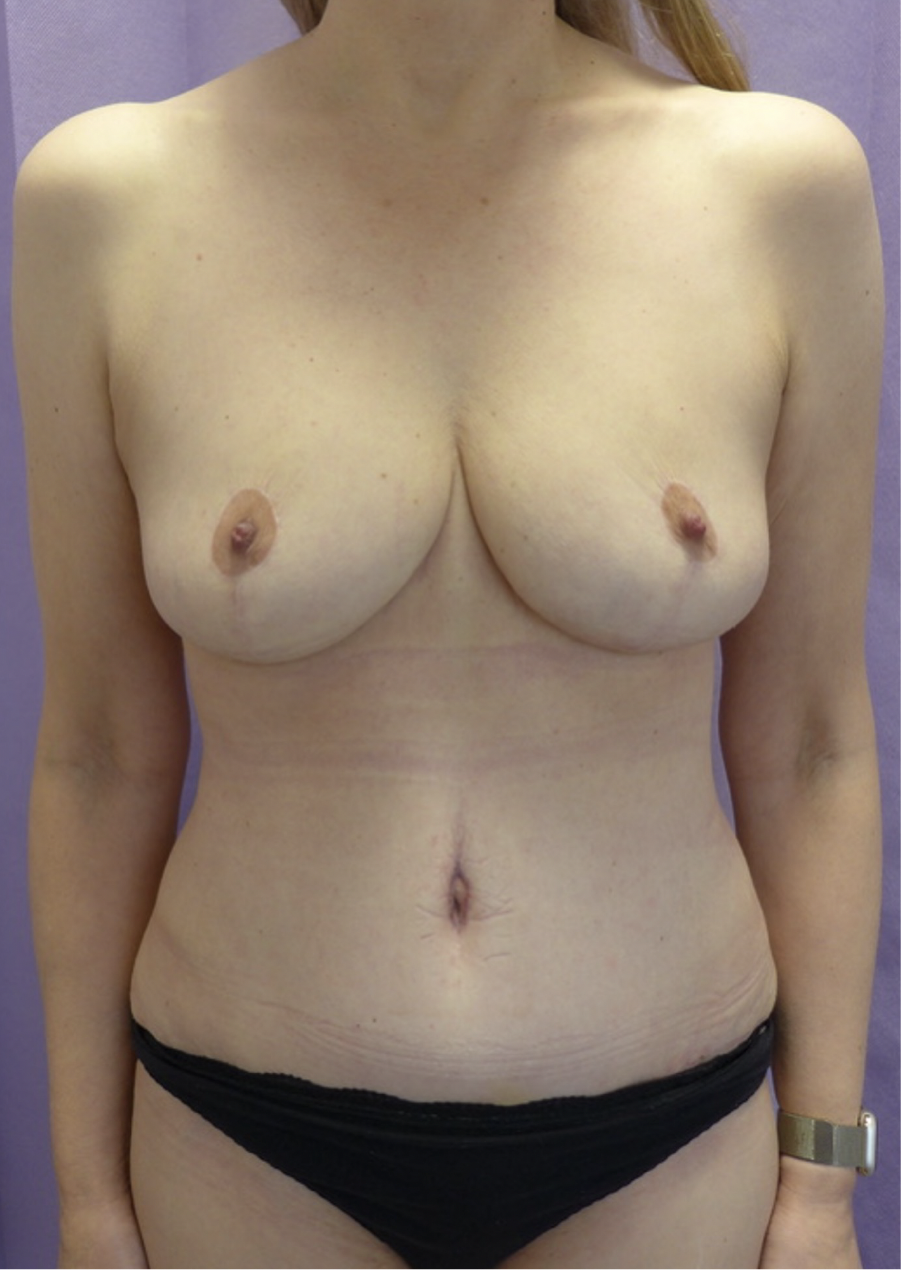 After — Breast Reduction & Abdominoplasty after Weight Loss