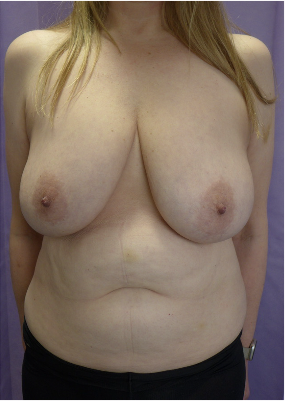 Before — Breast Reduction & Abdominoplasty after Weight Loss