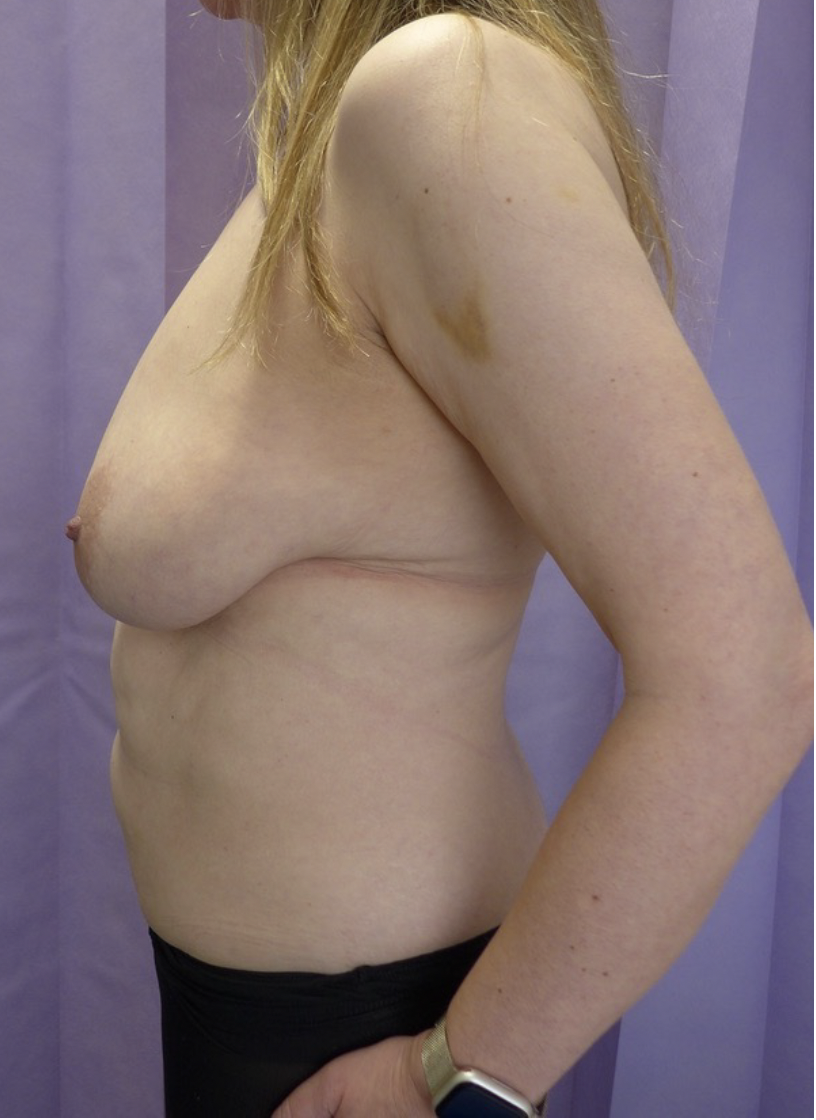 Before — Breast Reduction & Abdominoplasty after Weight Loss lateral