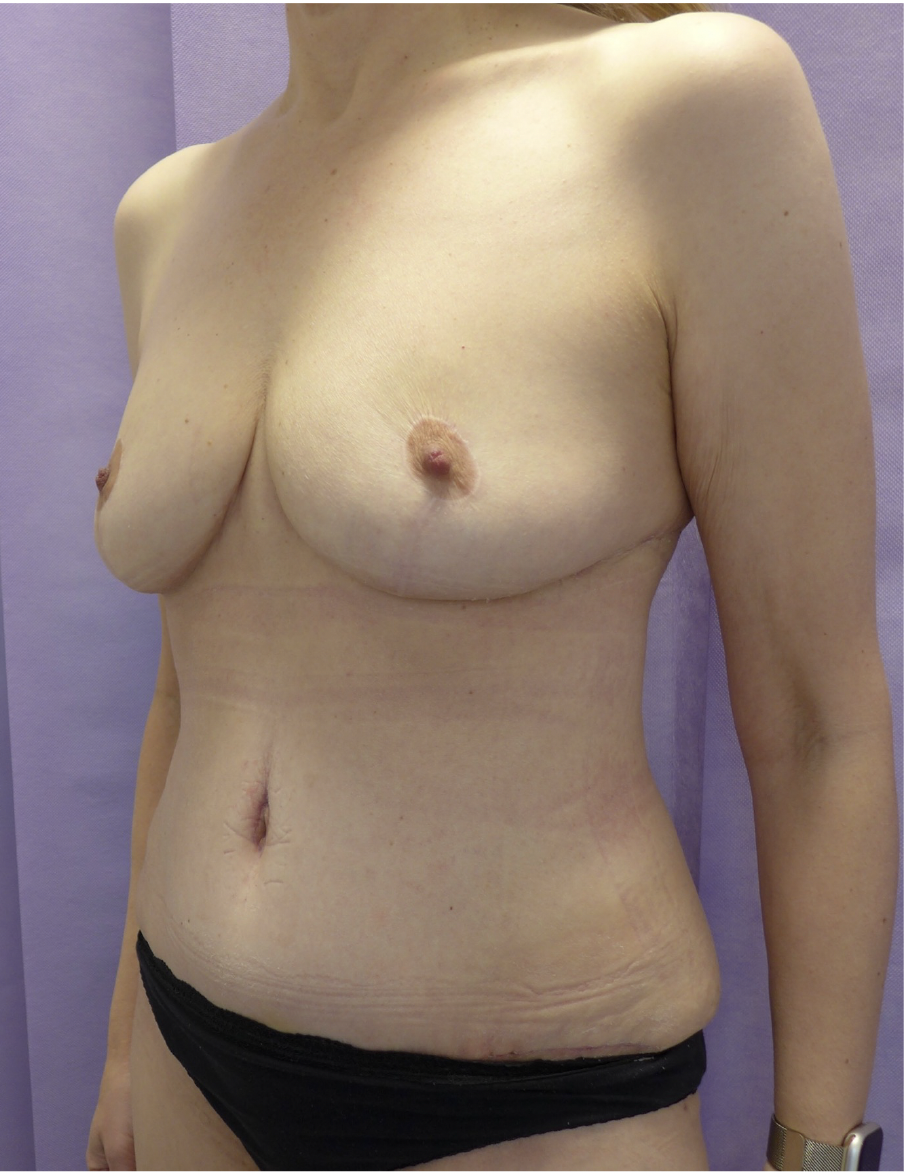 After — Breast Reduction & Abdominoplasty after Weight Loss oblique