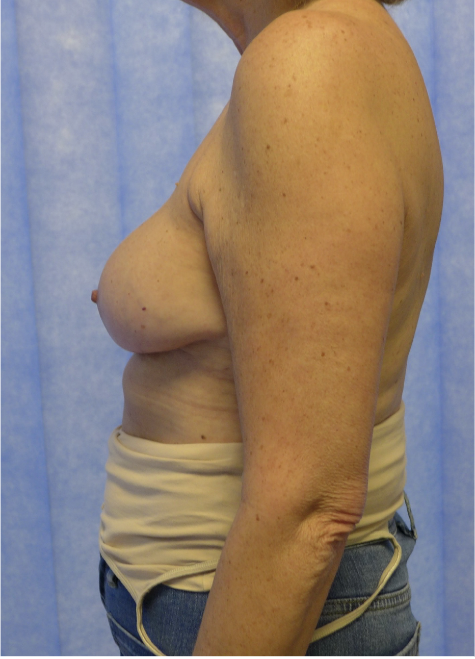 After — Implant Removal, Capsulectomy & Mastopexy lateral