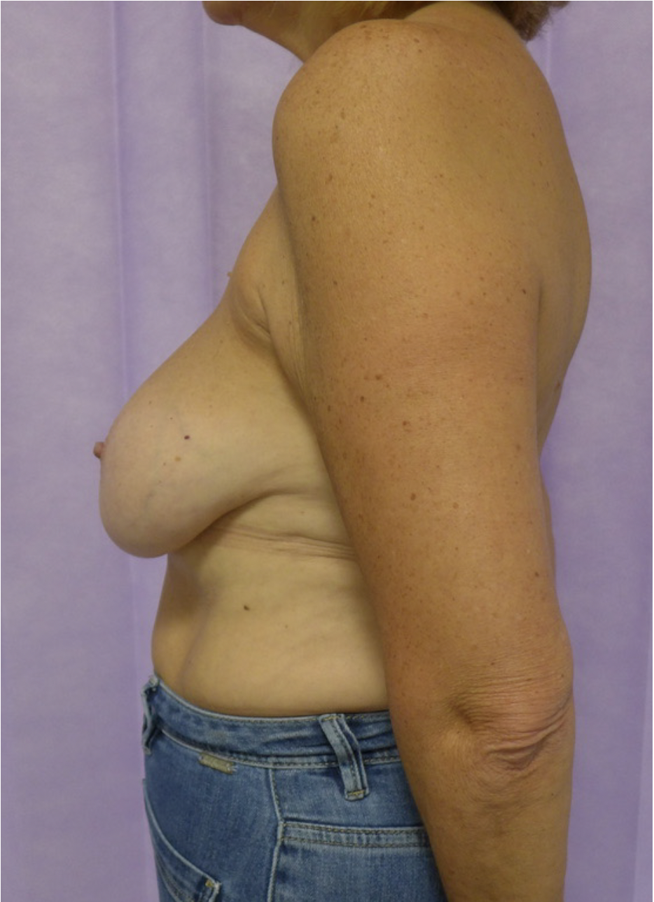 Before — Implant Removal, Capsulectomy & Mastopexy lateral