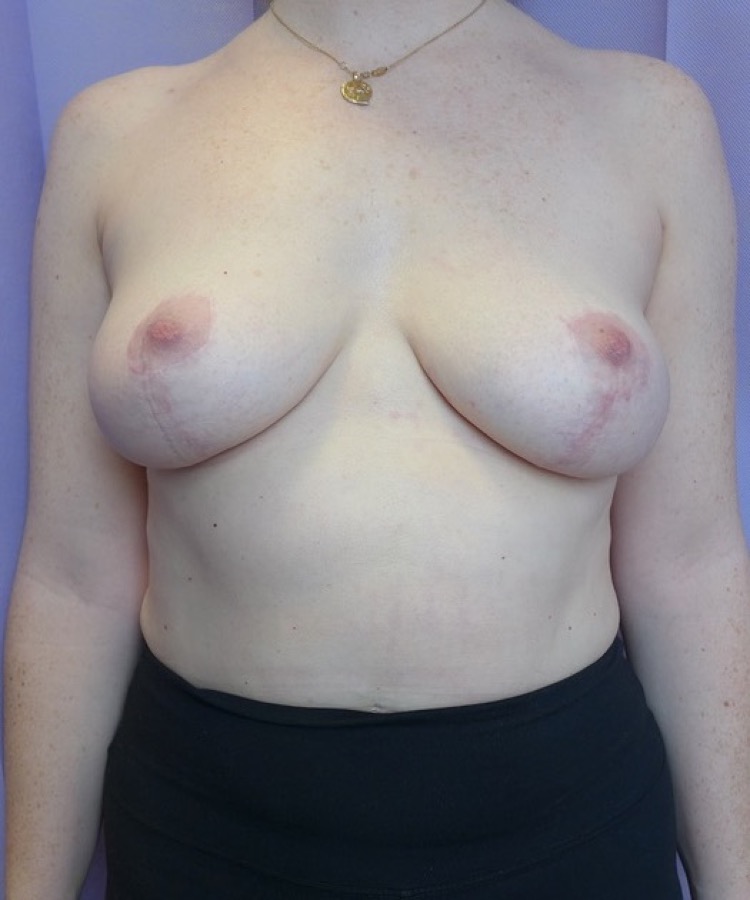After — Implant Removal, Capsulectomy, Mastopexy & Fat Grafting