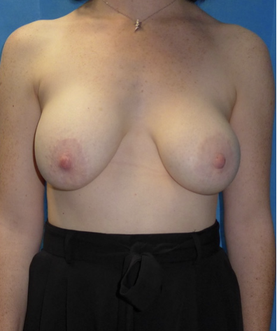 Before — Implant Removal, Capsulectomy, Mastopexy & Fat Grafting