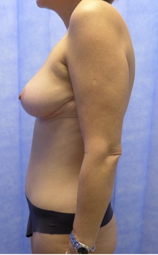 After — Redo Breast Reduction & Abdominoplasty lateral