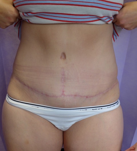 After: Redo Abdominoplasty with Umbilical Reconstruction AP