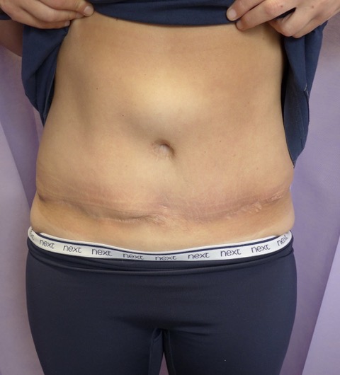 Before: Redo Abdominoplasty with Umbilical Reconstruction AP