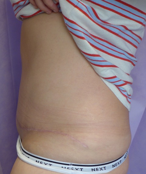 After: Redo Abdominoplasty with Umbilical Reconstruction lateral