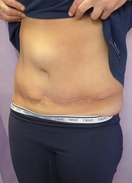 Before: Redo Abdominoplasty with Umbilical Reconstruction oblique