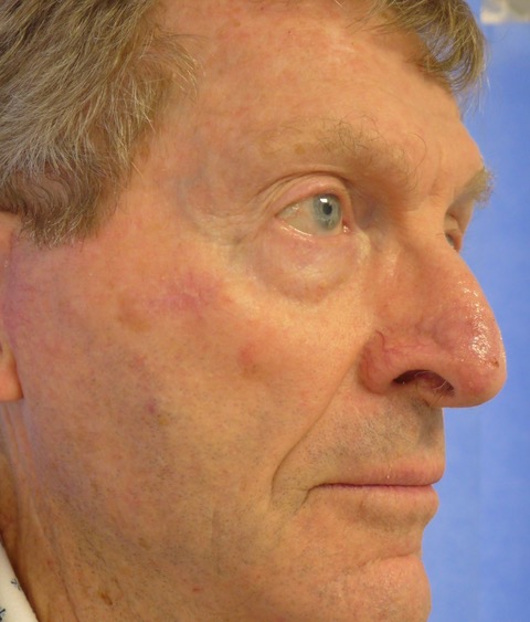 After — SCC excision nasal tip with full thickness skin graft, 2 weeks post-operatively