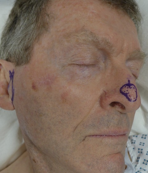 Before — SCC excision nasal tip with operative markings