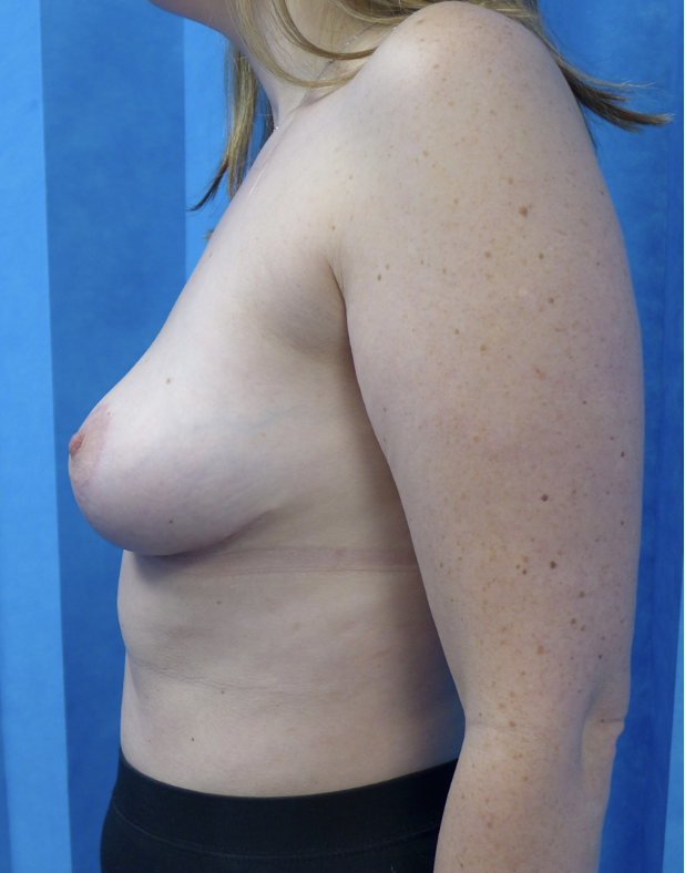 After — Implant Removal, Capsulectomy, Mastopexy & Fat Grafting lateral
