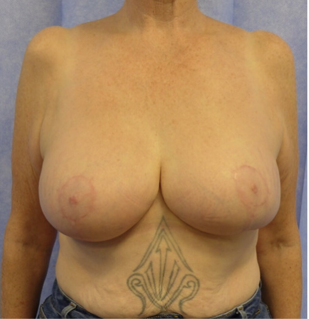 After — Weight Loss Mastopexy with Auto-Augmentation AP