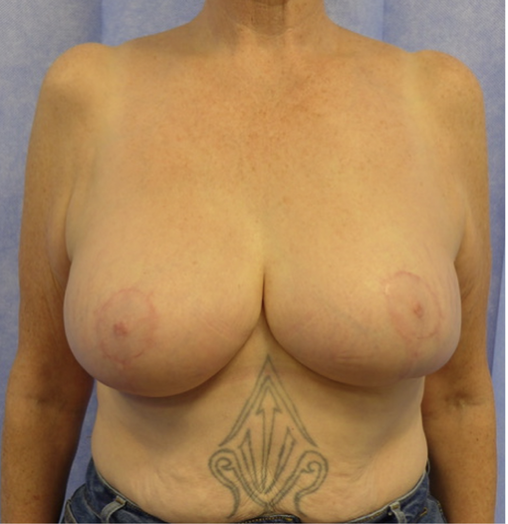 After — Weight Loss Mastopexy with Auto-Augmentation AP