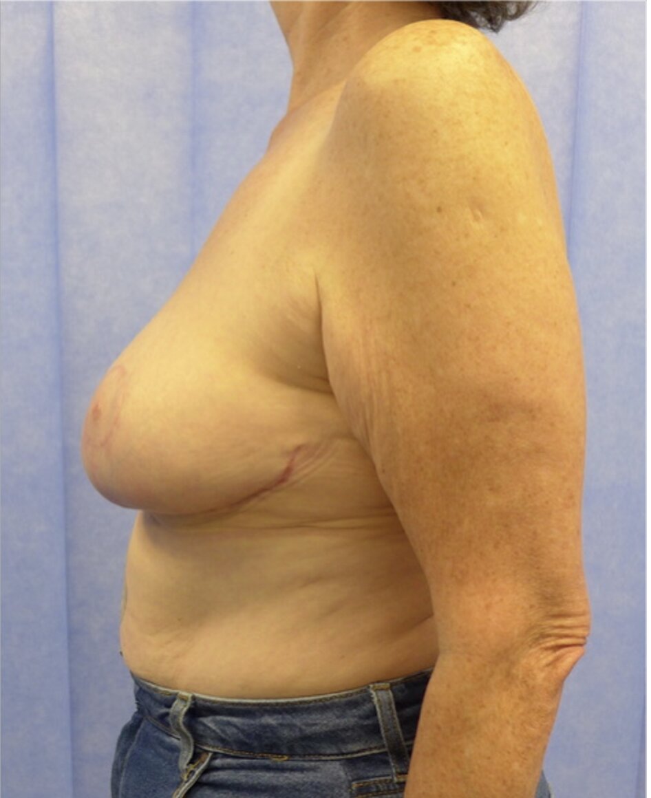After — Weight Loss Mastopexy with Auto-Augmentation lateral