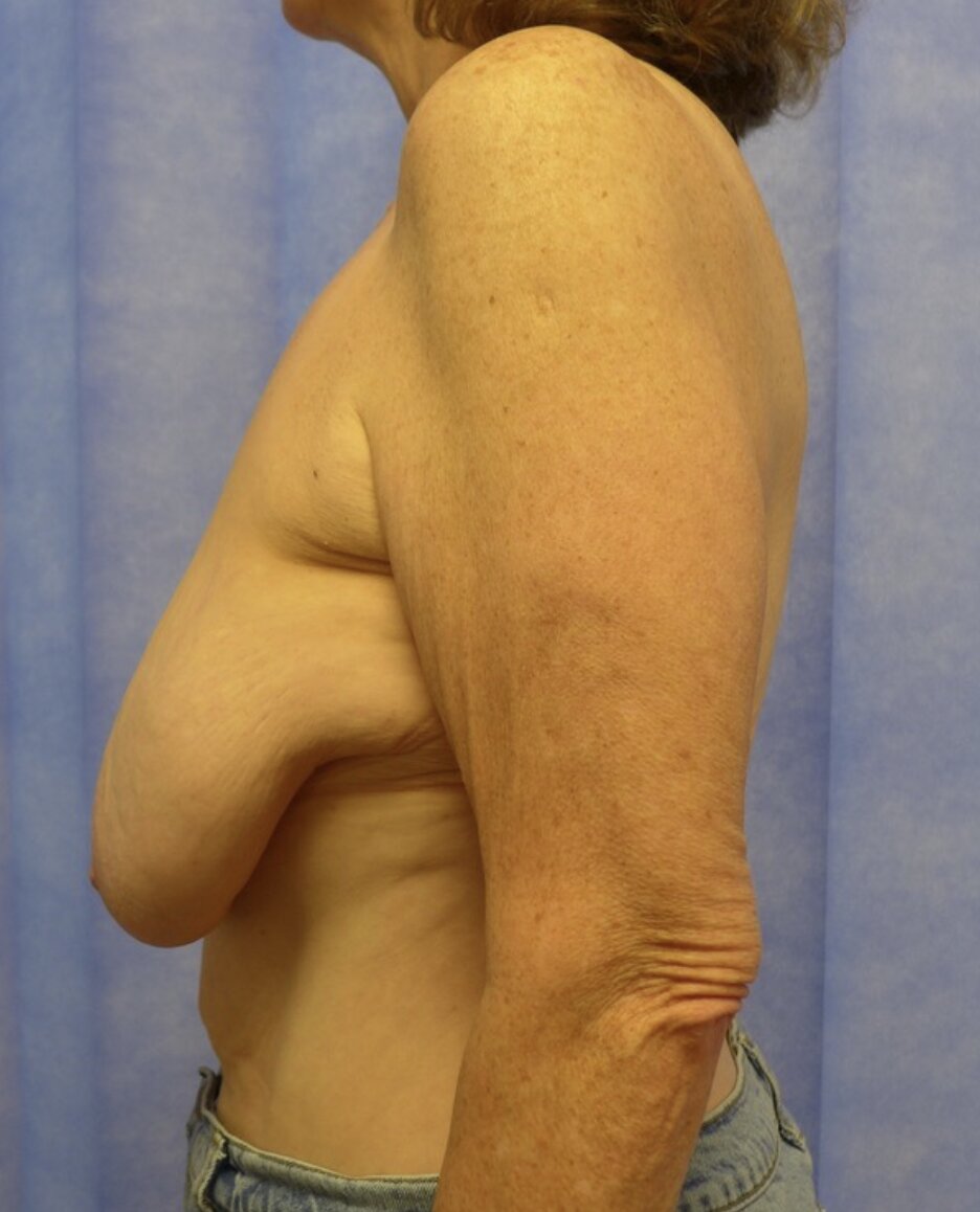 Before — Weight Loss Mastopexy with Auto-Augmentation lateral